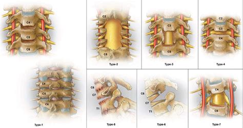Sagittal Balance Of The Cervical Spine Justin K Scheer Darryl Lau