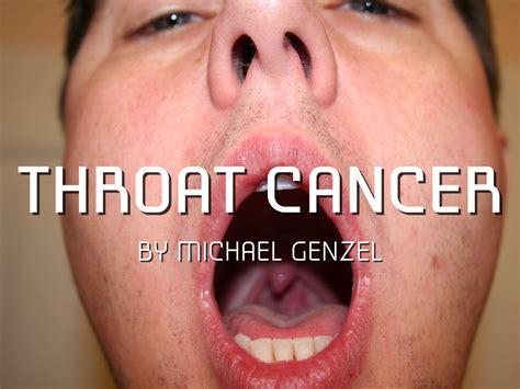 Throat Cancer By Michael Genzel