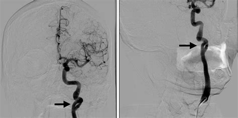 Unusual Case Of Traumatic Cervical Internal Carotid Artery Dissection