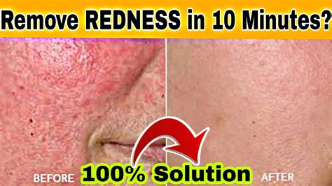 How To Get Rid Of Face Redness At Home With Natural Remedies चेहरा