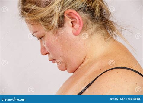 Uma Mulher Caucasiano Dos Anos De Idade Com Rompimento Excesso De Peso E Hormonal Mostra Sua