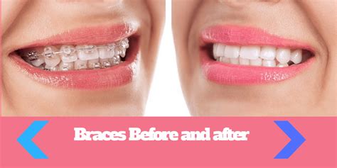 Braces Before And After 5 Facts You Should Know Before Getting Braces