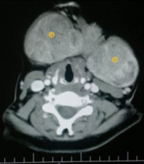 Axial Image Of Contrast Enhanced Ct Scan Showing The Localization Of