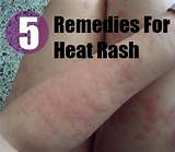 Images of How To Treat Heat Rash In Adults