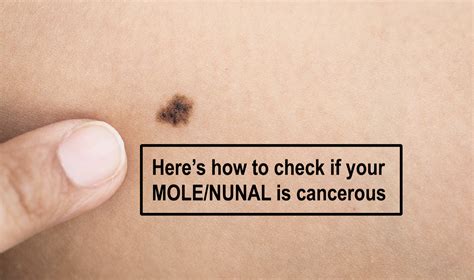 How To Know If Your Moles Are Cancerous Or Not Signs And Symptoms Artikuloblogazine