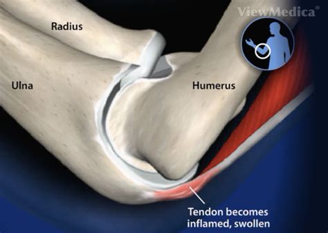 These pictures of this page are about:forearm tendons and ligaments. Golfers Elbow Doctor Dallas