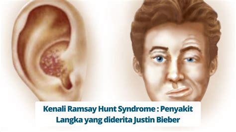 Kenali Ramsay Hunt Syndrome Penyakit Langka Yang Diderita Justin Bieber Primaya Hospital
