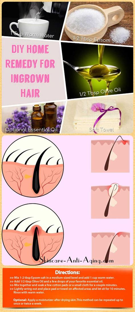 Perfect Diy Home Remedy For Ingrown Hair Removal Ingrown Hair Removal