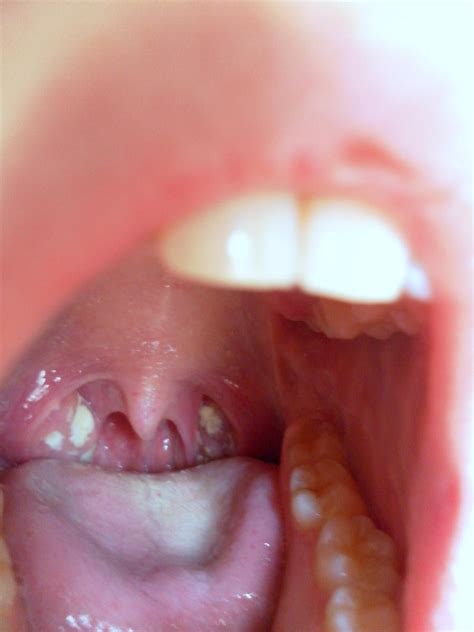 Normal Throat Looks Like Close Up Of Lymphoid Tissue On The Throat Of