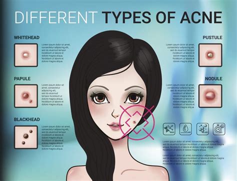 Best Steps To Rid Yourself Of Acne Bioptimizers