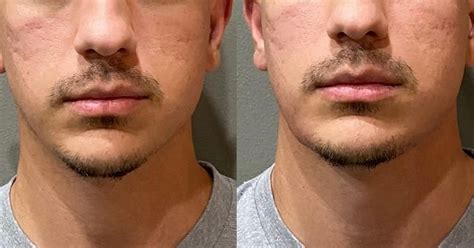 Houston Male Facial Sculpting For Better Jawline — Lush Rx — Lush Rx
