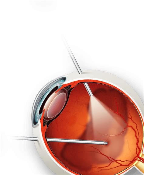 Vitrectomy