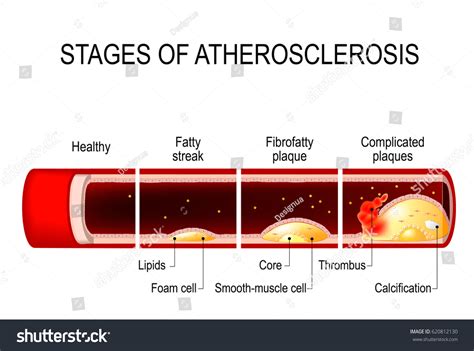 Stages Atherosclerosis Detailed Illustration Healthy Artery