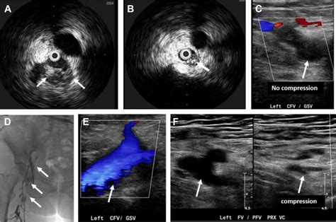 Innovations In Vascular Ultrasound Radiology Key