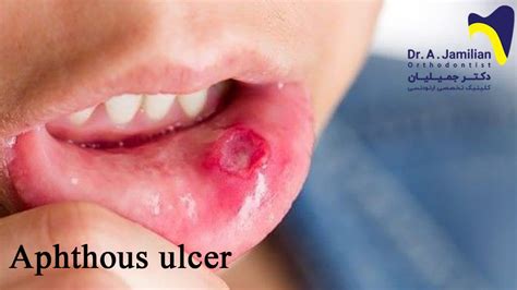 Aphthous Ulcer And Its Treatment Dr Jamilian