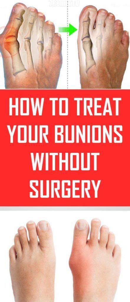How To Treat Your Bunions Without Surgery How To Treat Bunions