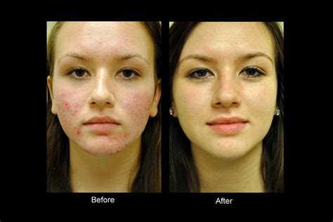 Best Acne Scars Treatment Products Acne Treatments Is Dermabrasion
