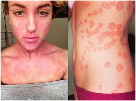 Veja mais ideias sobre psoríase, psoríase tratamento, psoriase couro cabeludo. Psoríase: doença autoimune não é contagiosa, mas ...