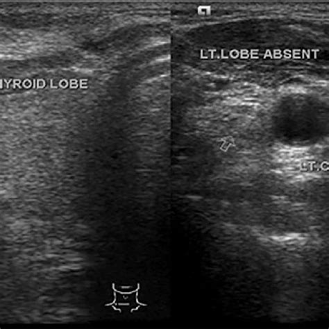 Ultrasonography Transverse Section Of Lower Neck Showing Normal Right