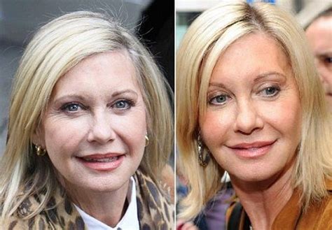 Olivia Newton John Plastic Surgery Plastic Surgery Olivia Newton