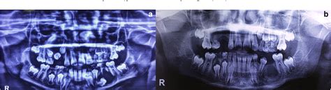 Figure 1 From Bi Maxillary Dentigerous Cyst In A Non Syndromic Child