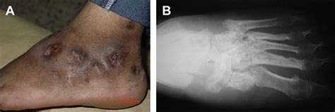 Tropical Fungal Infections Infectious Disease Clinics