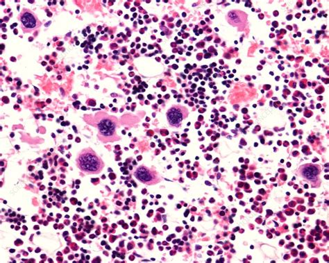 Megakaryocytes In Bone Marrow Light Marrow Stock Image C0480069