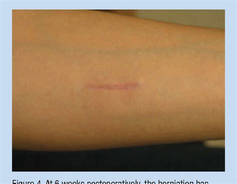 Treatment Of A Symptomatic Forearm Muscle Herniation With A Mesh Graft