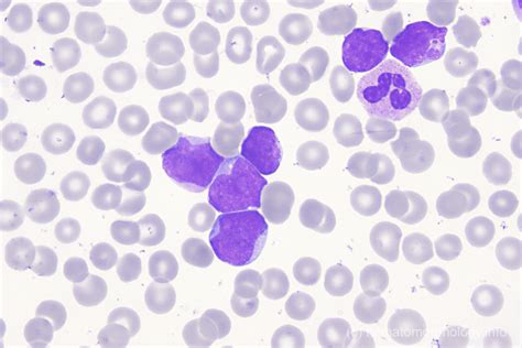 Blasts Hematomorphology A Databank Imagebank For Hematology Blood