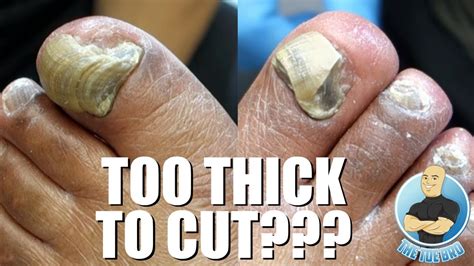 Trimming Extremely Thick Toenails Full Treatment Youtube