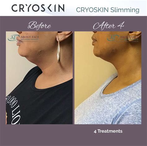 Cryoskin 30 Less Fat Tighter Skin Same You