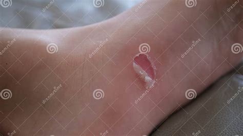 Blisters Skin On The Soles Of The Feet Stock Photo Image Of Footcare