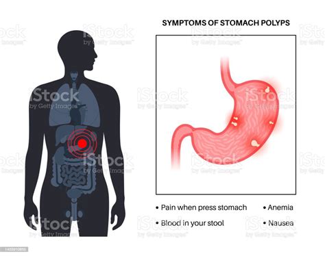 Stomach Polyp Disease Stock Illustration Download Image Now Adenoma