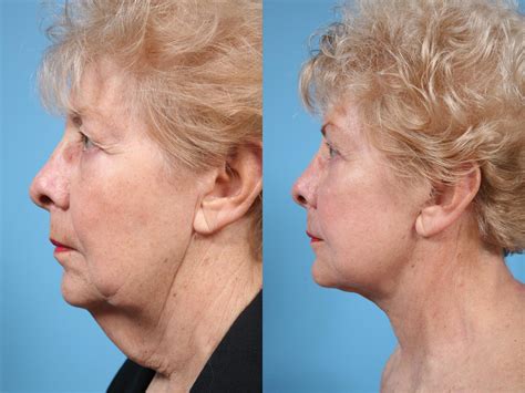neck lift before and after photos patient 67 chicago il tlkm plastic surgery