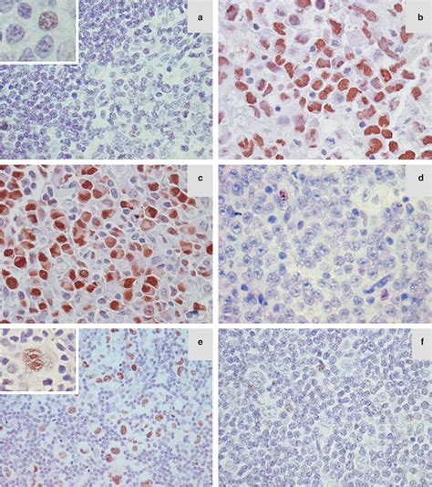 Expression Of Junb In Reactive Lymph Nodes And Cd30 Lymphomas A