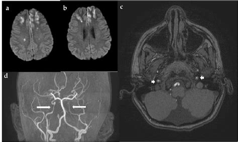 Figure 5 From Periventricular Lesions Of Brain In Adults A Pictorial