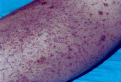 Leukemia Red Spots Petechiae