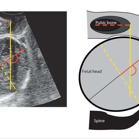 Ultrasound Image And Drawing To Demonstrate The Fetal Head Direction