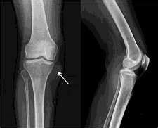 Radiograph Knee A P And Lateral View Showing Soft Tissue Swelling