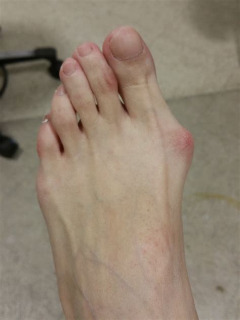 Bunion Lateral Foot