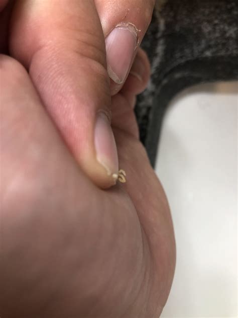 S shaped blackhead popped from my nose : r/popping