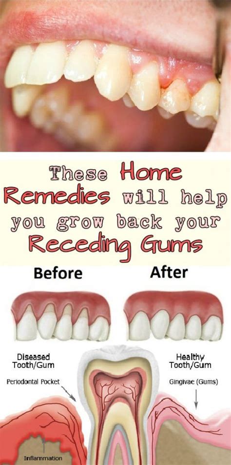 These Home Remedies Will Help You Grow Back Your Receding Gums
