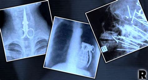 Inside Story Weird Objects And Horrifying Injuries Caught On X Ray