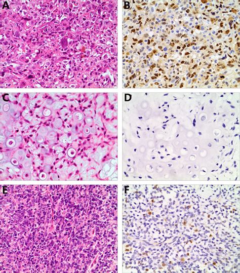 Kpna2 Immunostaining In Osteosarcoma Chondrosarcoma And Ewing Sarcoma