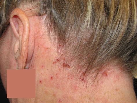 Atopic Dermatitis Causes Symptoms Diagnosis Treatment Prognosis