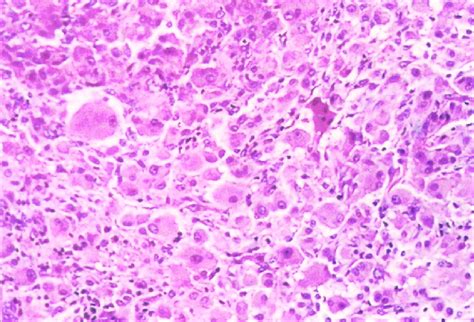 Multinucleated Giant Cells And Histiocytes With Eosinophilic Cytoplasm