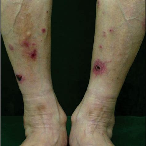 Erythematous Ulcers On The Lower Extremities Download Scientific Diagram