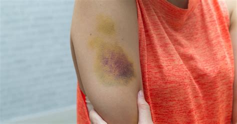 10 Unexpected Signs Bruising Is Part Of A Larger Health Condition