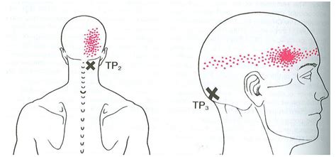 Head Pain Back Of Head The Complete Headache Chart