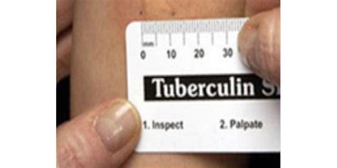 Mantoux Tuberculin Skin Testing Products Guides Toolkits